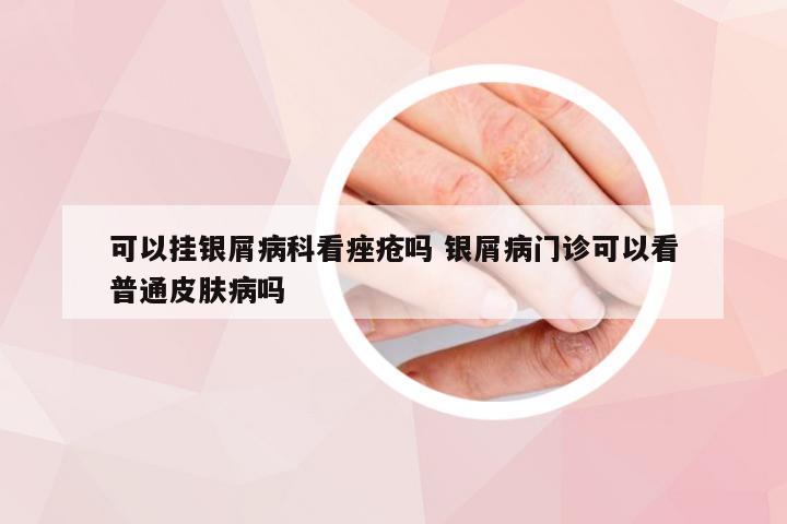 可以挂银屑病科看痤疮吗 银屑病门诊可以看普通皮肤病吗