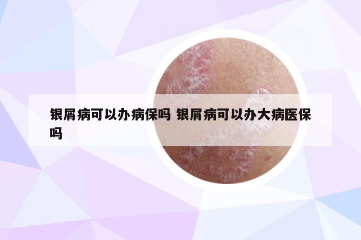 银屑病可以办病保吗 银屑病可以办大病医保吗