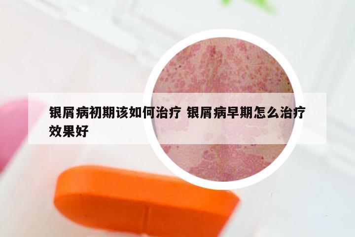 银屑病初期该如何治疗 银屑病早期怎么治疗效果好