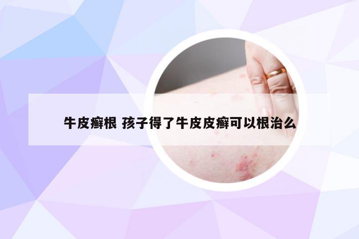 牛皮癣根 孩子得了牛皮皮癣可以根治么