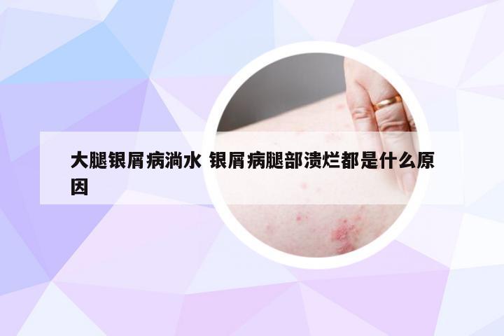 大腿银屑病淌水 银屑病腿部溃烂都是什么原因