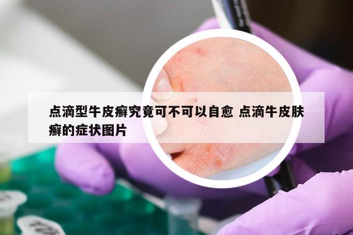 点滴型牛皮癣究竟可不可以自愈 点滴牛皮肤癣的症状图片