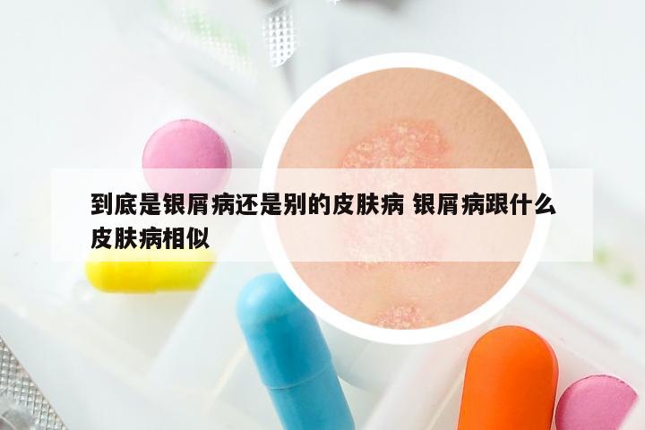 到底是银屑病还是别的皮肤病 银屑病跟什么皮肤病相似