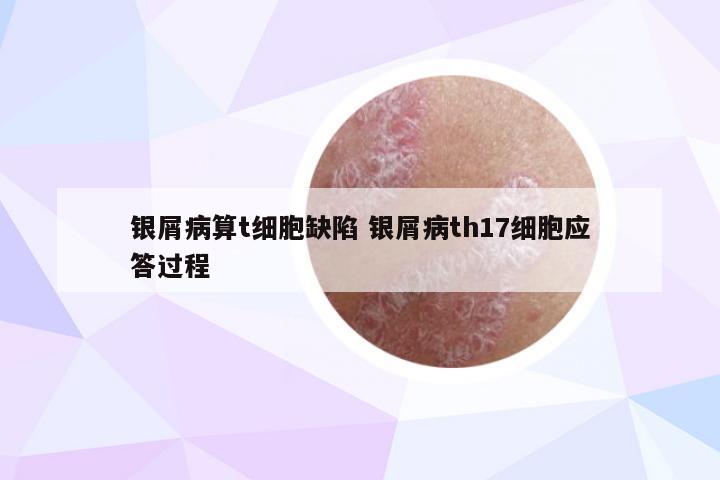 银屑病算t细胞缺陷 银屑病th17细胞应答过程