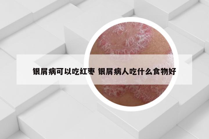 银屑病可以吃红枣 银屑病人吃什么食物好