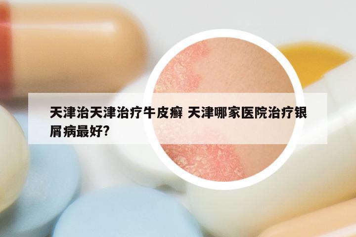 天津治天津治疗牛皮癣 天津哪家医院治疗银屑病最好?