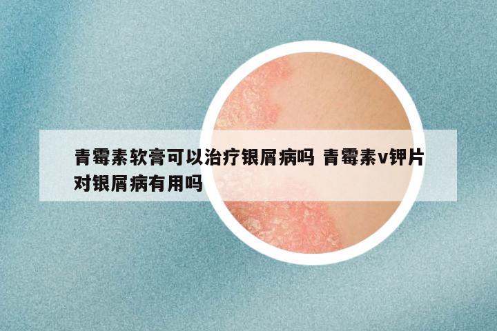 青霉素软膏可以治疗银屑病吗 青霉素v钾片对银屑病有用吗