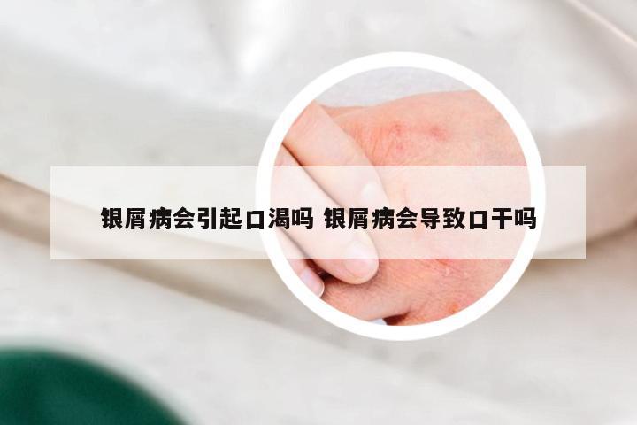 银屑病会引起口渴吗 银屑病会导致口干吗