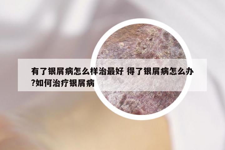 有了银屑病怎么样治最好 得了银屑病怎么办?如何治疗银屑病