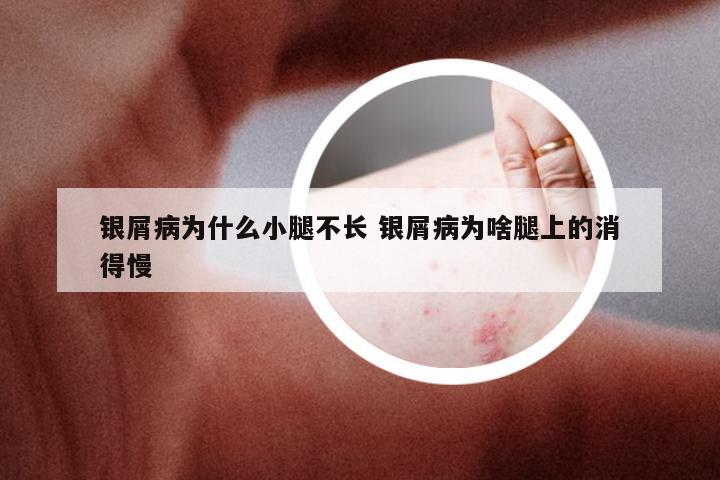 银屑病为什么小腿不长 银屑病为啥腿上的消得慢