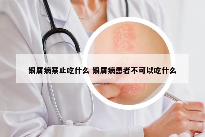 银屑病禁止吃什么 银屑病患者不可以吃什么