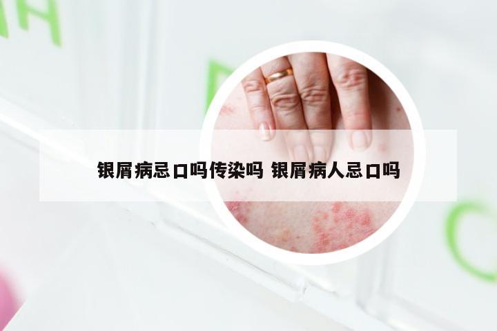 银屑病忌口吗传染吗 银屑病人忌口吗