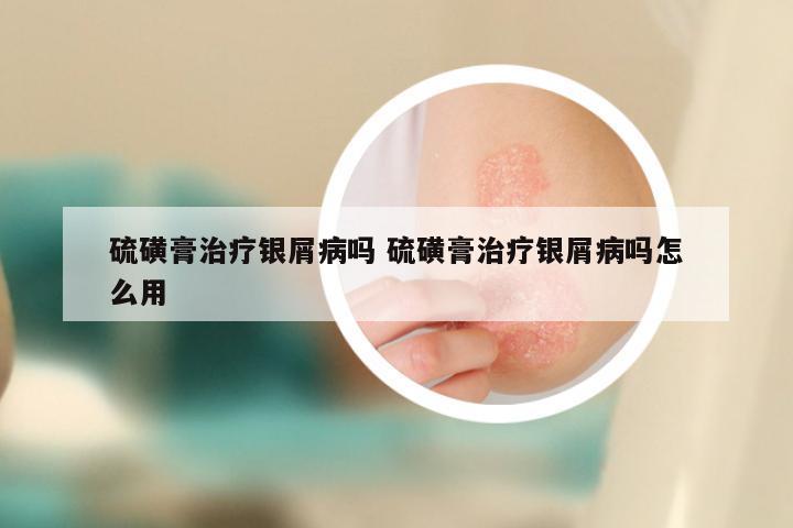 硫磺膏治疗银屑病吗 硫磺膏治疗银屑病吗怎么用