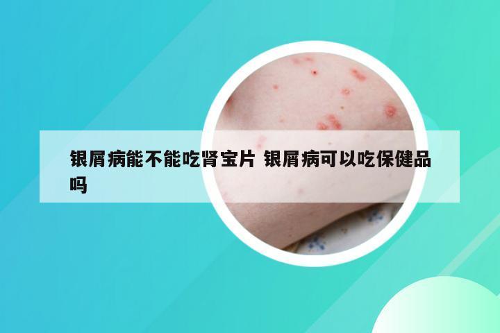 银屑病能不能吃肾宝片 银屑病可以吃保健品吗