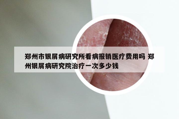 郑州市银屑病研究所看病报销医疗费用吗 郑州银屑病研究院治疗一次多少钱