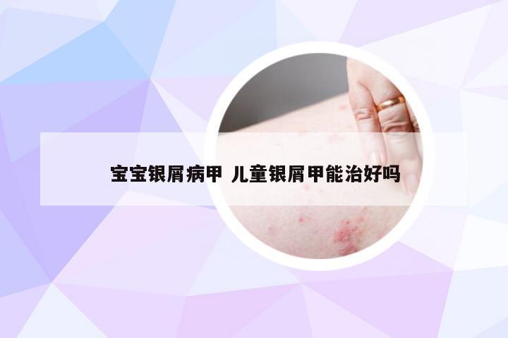 宝宝银屑病甲 儿童银屑甲能治好吗