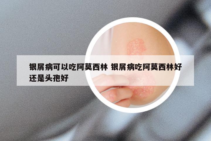 银屑病可以吃阿莫西林 银屑病吃阿莫西林好还是头孢好