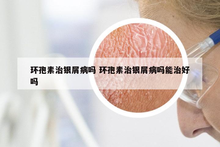 环孢素治银屑病吗 环孢素治银屑病吗能治好吗