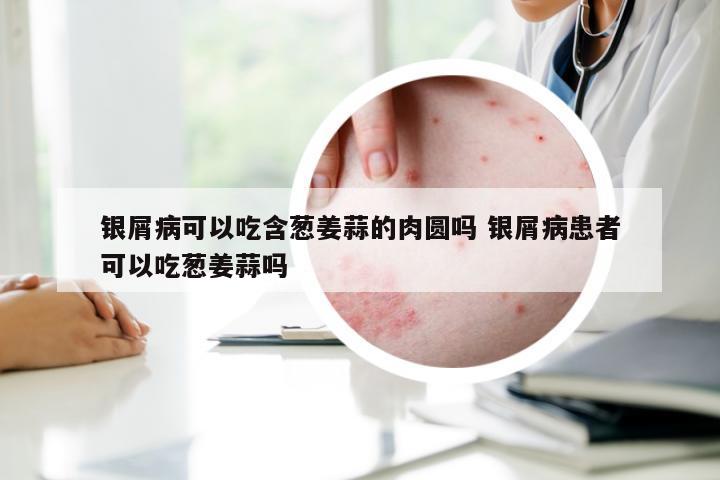 银屑病可以吃含葱姜蒜的肉圆吗 银屑病患者可以吃葱姜蒜吗