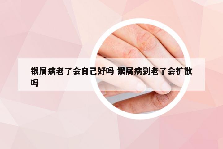 银屑病老了会自己好吗 银屑病到老了会扩散吗