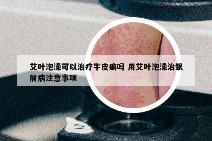 艾叶泡澡可以治疗牛皮癣吗 用艾叶泡澡治银屑病注意事项