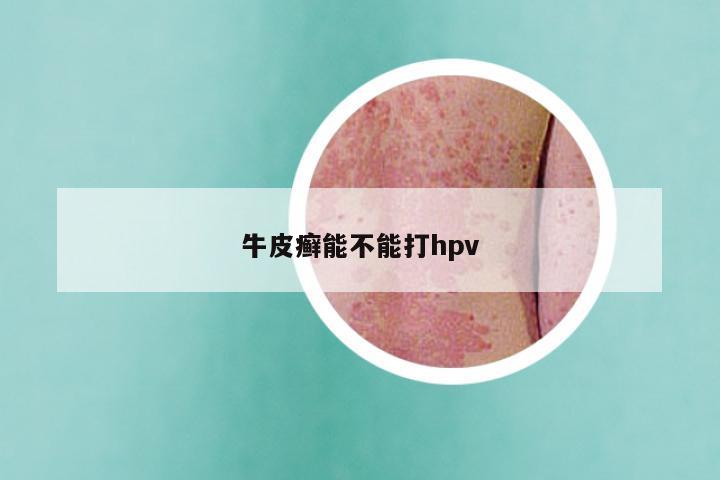 牛皮癣能不能打hpv