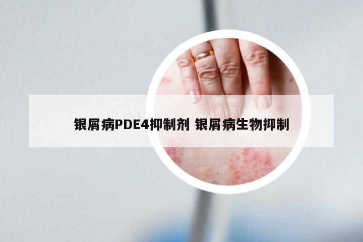 银屑病PDE4抑制剂 银屑病生物抑制