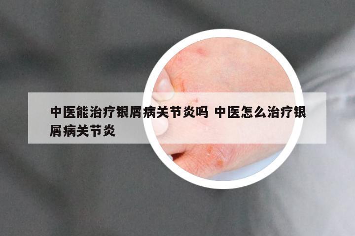 中医能治疗银屑病关节炎吗 中医怎么治疗银屑病关节炎