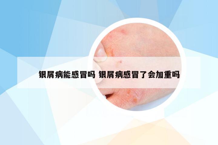 银屑病能感冒吗 银屑病感冒了会加重吗