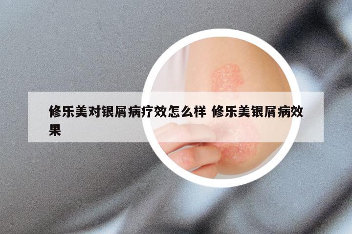 修乐美对银屑病疗效怎么样 修乐美银屑病效果