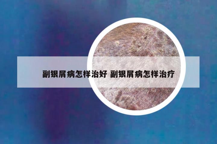 副银屑病怎样治好 副银屑病怎样治疗