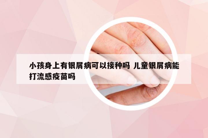 小孩身上有银屑病可以接种吗 儿童银屑病能打流感疫苗吗