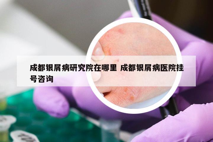 成都银屑病研究院在哪里 成都银屑病医院挂号咨询