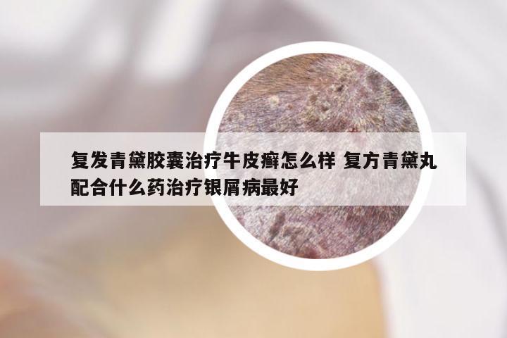 复发青黛胶囊治疗牛皮癣怎么样 复方青黛丸配合什么药治疗银屑病最好