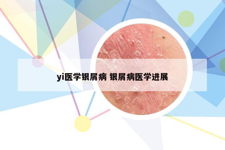 yi医学银屑病 银屑病医学进展