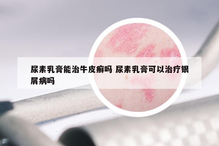 尿素乳膏能治牛皮癣吗 尿素乳膏可以治疗银屑病吗