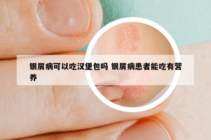 银屑病可以吃汉堡包吗 银屑病患者能吃有营养