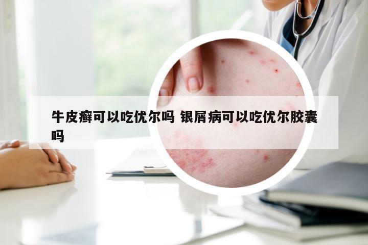 牛皮癣可以吃优尔吗 银屑病可以吃优尔胶囊吗