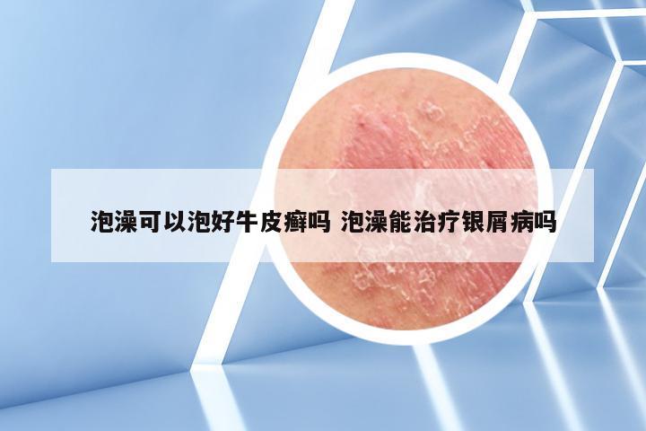 泡澡可以泡好牛皮癣吗 泡澡能治疗银屑病吗