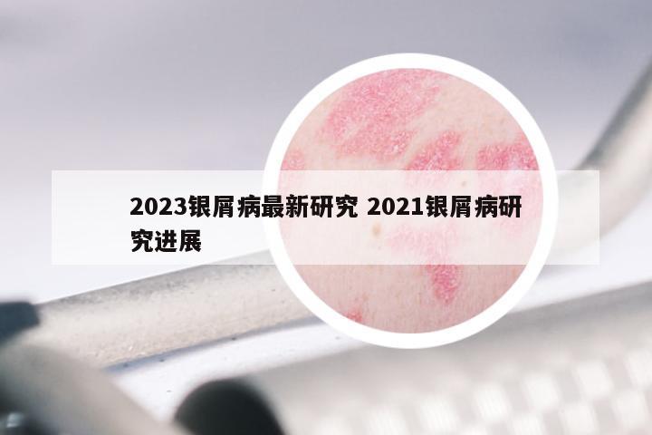 2023银屑病最新研究 2021银屑病研究进展