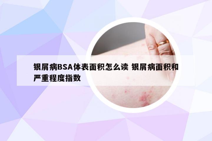 银屑病BSA体表面积怎么读 银屑病面积和严重程度指数