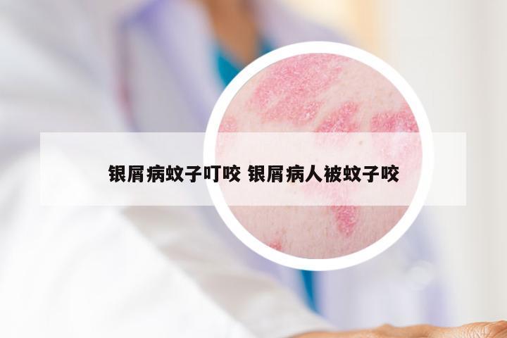 银屑病蚊子叮咬 银屑病人被蚊子咬