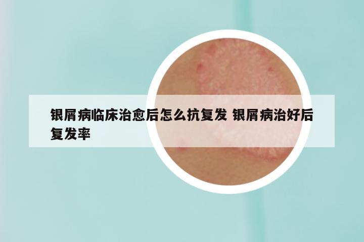 银屑病临床治愈后怎么抗复发 银屑病治好后复发率