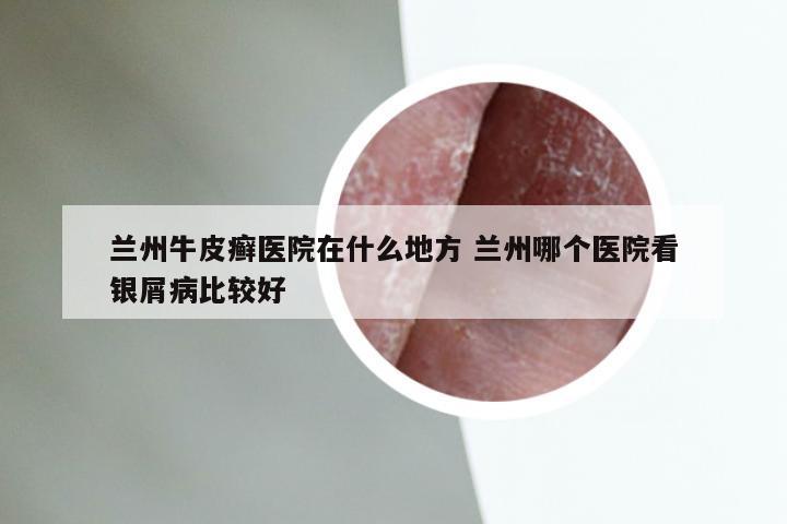 兰州牛皮癣医院在什么地方 兰州哪个医院看银屑病比较好