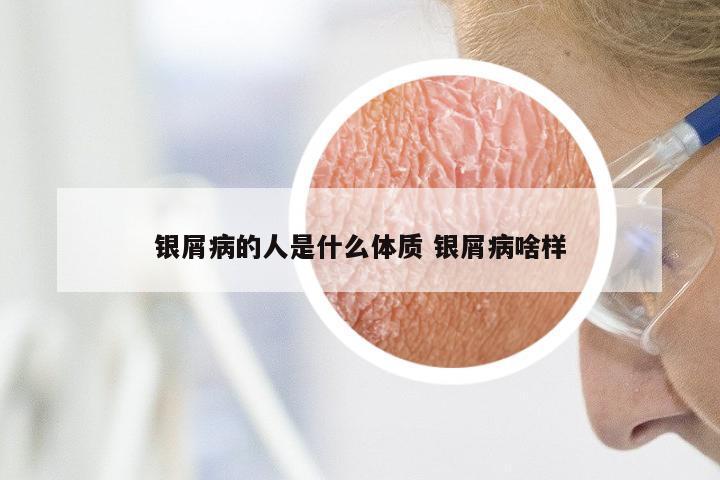 银屑病的人是什么体质 银屑病啥样