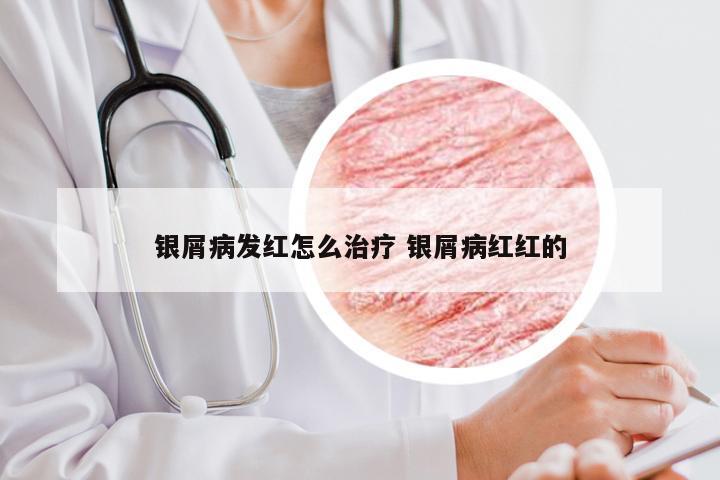 银屑病发红怎么治疗 银屑病红红的