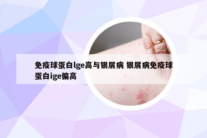 免疫球蛋白lge高与银屑病 银屑病免疫球蛋白ige偏高