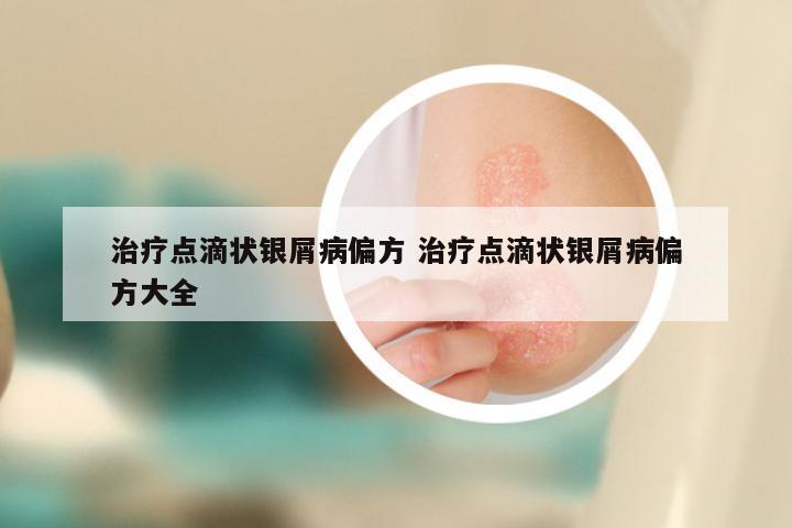 治疗点滴状银屑病偏方 治疗点滴状银屑病偏方大全