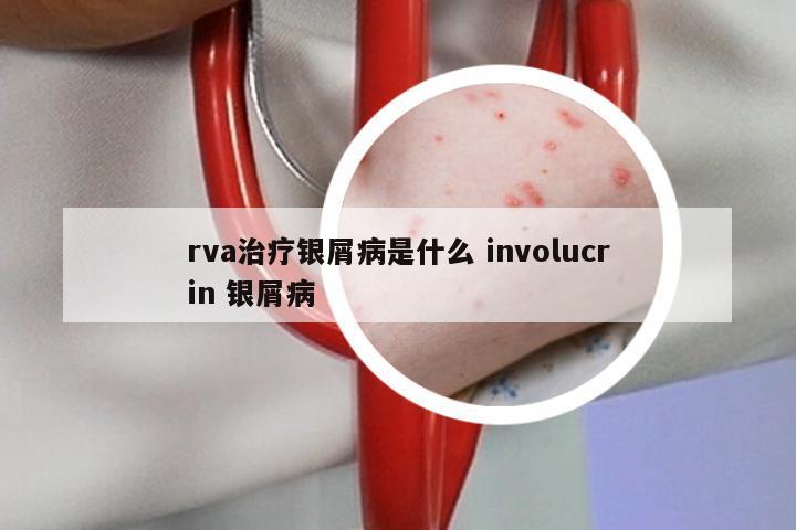 rva治疗银屑病是什么 involucrin 银屑病