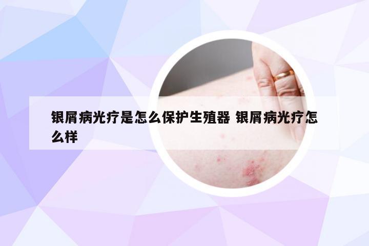 银屑病光疗是怎么保护生殖器 银屑病光疗怎么样